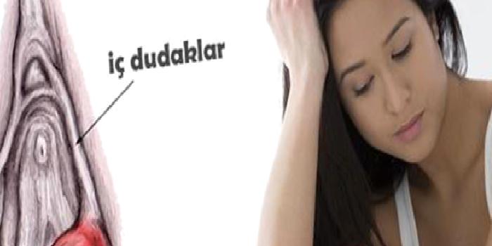 Bartholin Kisti ve Apsesi Nedir? Tedavisi Nasıl Yapılır?