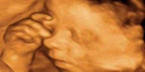 Detaylı Fetal Ultrasonografi (İkinci Trimester Ultrasonografisi)