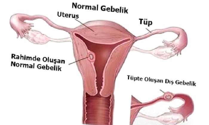 Dış Gebelik (Ektopik Gebelik)