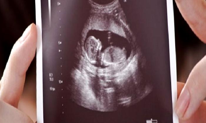 Down Sendromu hakkında her şey…