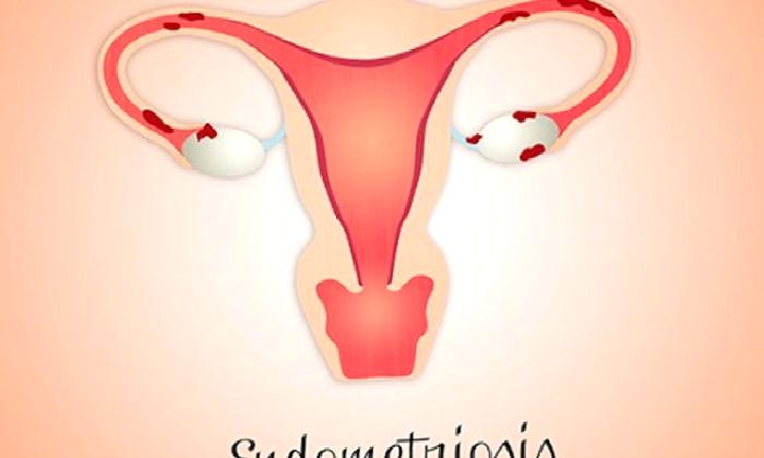 Endometriozis belirtileri nelerdir?