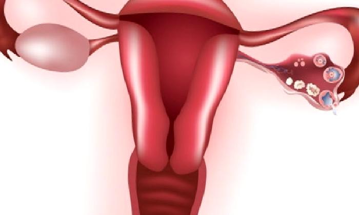 Endometriozis ( Çikolata Kisti )