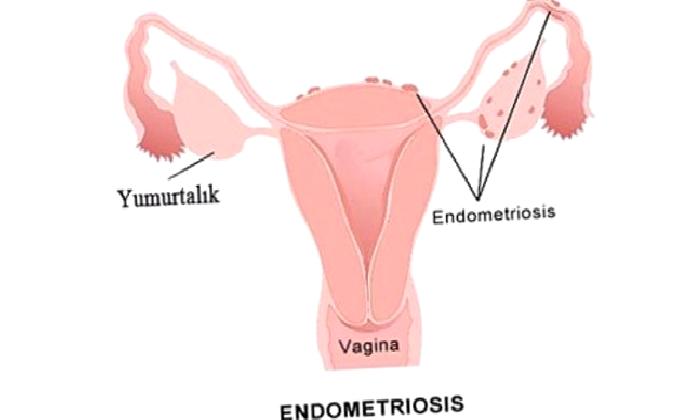 Endometriozis Nedir?