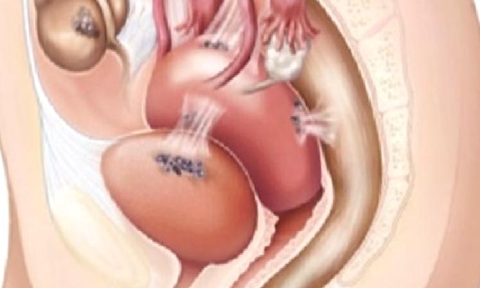 Endometriozis sıklığı nedir?