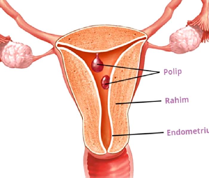 Endometriyal polipler neden önemlidir?