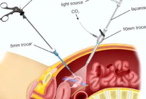JİNEKOLOJİDE LAPAROSKOPİK CERRAHİ