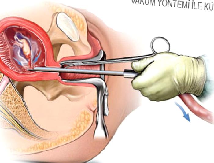 Kürtaj – Gebelik Sonlandırması