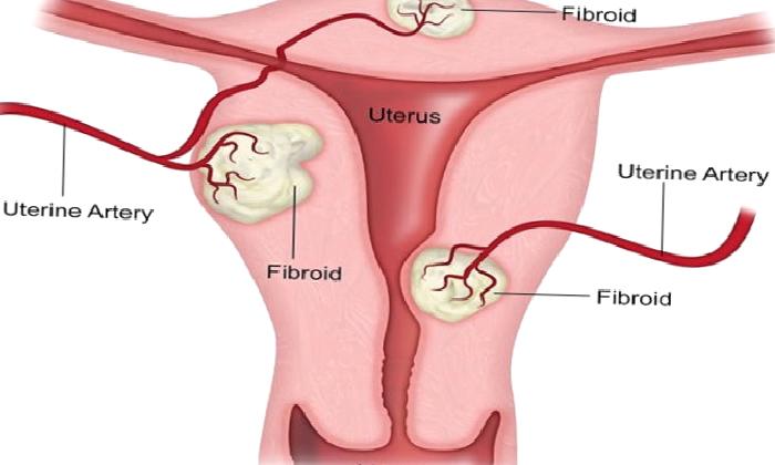 Miyomların Tanı ve Tedavisi