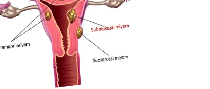 Miyomların Tanı ve Tedavisi