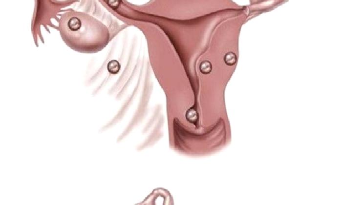 Mol Gebelik; Üzüm Gebeliği