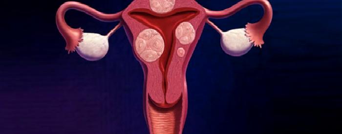 Myom Nedir? Nasıl Tedavi Edilir?