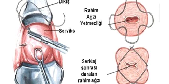 Rahim Ağzı Yetmezliği; Servikal Sörklaj