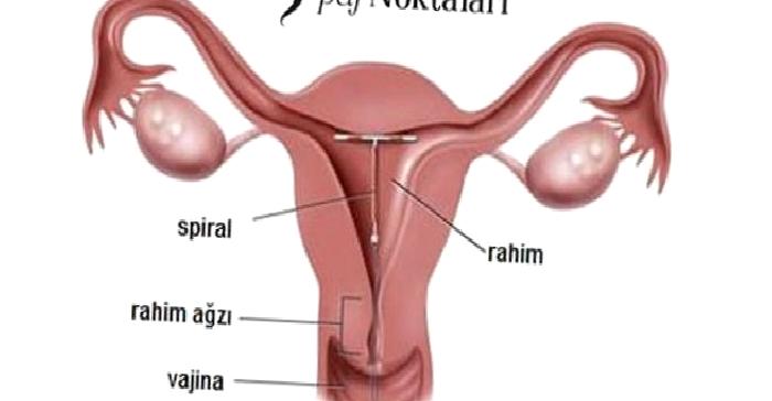 RAHİM İÇİ ARAÇ ( RIA , SPİRAL)