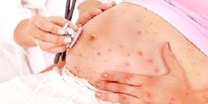 Suçiçeği ve Gebelik