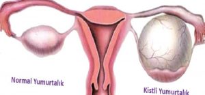Yumurtalık Kisti, Çeşitleri ve Belirtileri