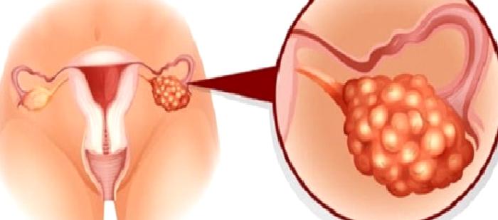 Yumurtalık Kistleri