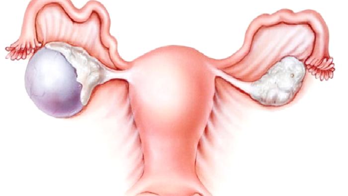 Yumurtalık Kistleri ve Yumurtalık Kanseri