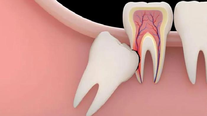 20 Yaş Dişleri Çekilmeli Mİ?