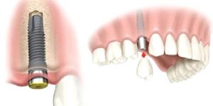 7 Factors to Know When You Get Dental Implants