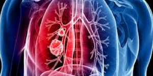 Akciğer Tüberkülozu