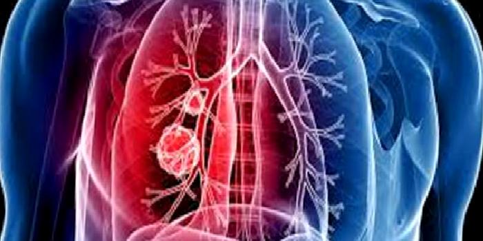 Akciğer Tüberkülozu