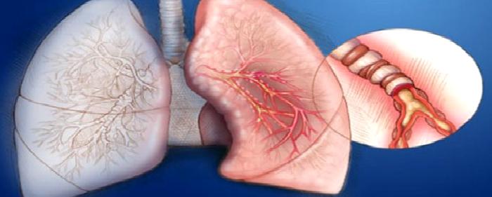 Akciğer Tüberkülozu