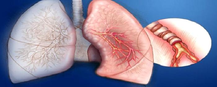 Akciğerde Nodül Nedir, Ne Değildir?