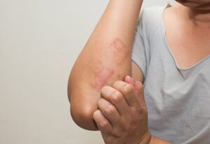 Akdeniz Diyeti ve Deri Sağlığı