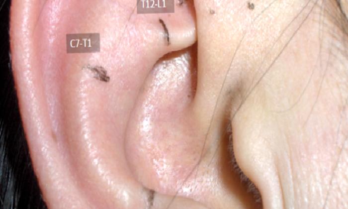 AKUPUNKTUR NELERİ TEDAVİ EDER?…(1)