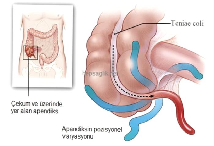 Akut Apandisit nedir?