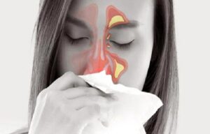 Alerjik Burun Hastalıkları