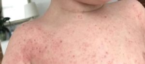 Altıncı Hastalık (Roseola İnfantum)