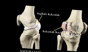 AMELİYATSIZ DİZ KİREÇLENMESİ TEDAVİSİ