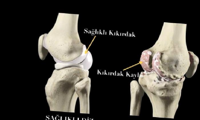 AMELİYATSIZ DİZ KİREÇLENMESİ TEDAVİSİ