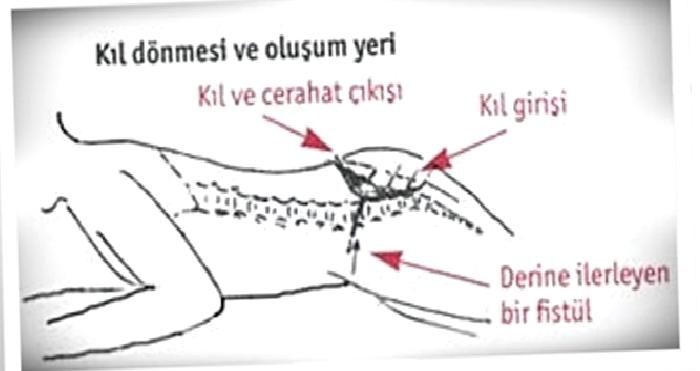 Ameliyatsız Kıl Dönmesi Tedavisi
