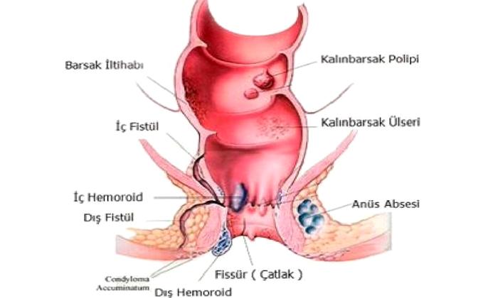 Anal Fissür