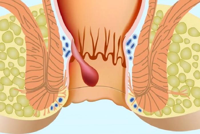 Anal Fissür (Makat Çatlağı)