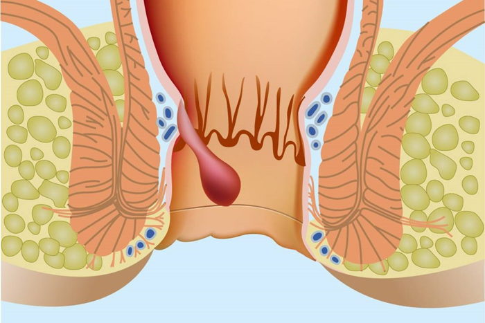 Anal Fissür ve Anal Fistül Nedir?