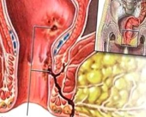 Anal fistül nedir ?