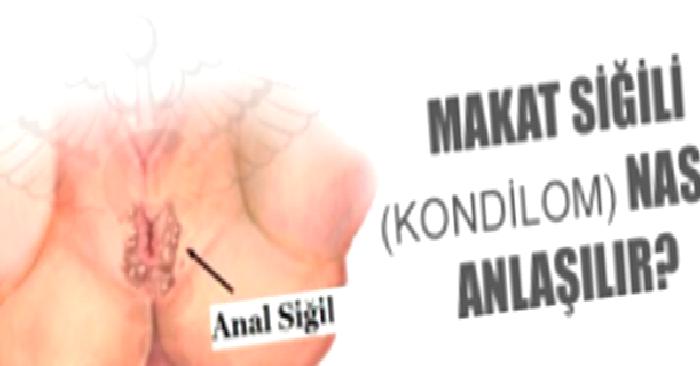 Anal Kondilom