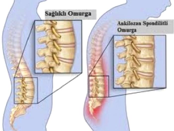 ANKİLOZAN SPONDİLİT
