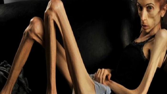 Anoreksiya Nevroza ve Beslenme Destek Tedavisi