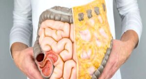 Aşırı Yağlı Besinle, Kolon Kanserini Tetikliyor!