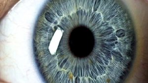 Astigmat Nedir?