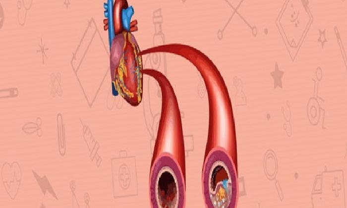 Atardamar (arter) Tıkanıklığı