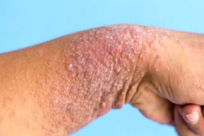 Atopik Dermatit – Çocukluk Çağı Egzeması