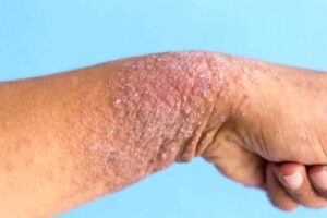 Atopik Dermatit (Egzama)