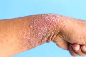 Atopik Dermatit Nedir?