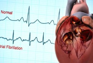 Atriyal Fibrilasyon Ablasyonu