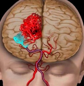 AVM (Arteriovenöz Malformasyon)  Beyinde Damar Yumağı